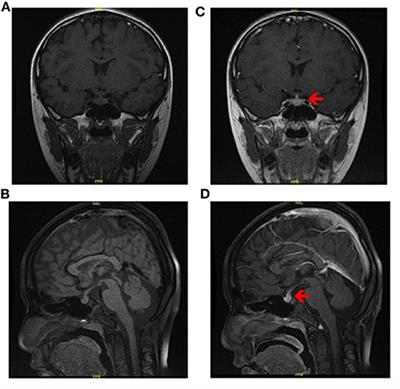 Case Report: Rosai-Dorfman Disease Involving Sellar Region in a Pediatric Patient: A Case Report and Systematic Review of Literature